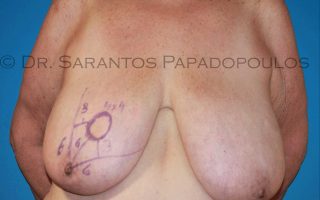 Ογκοπλαστική μαστού 17