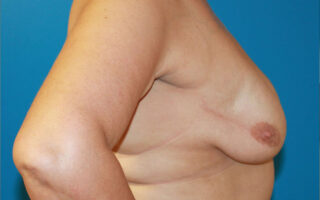 Ογκοπλαστική μαστού