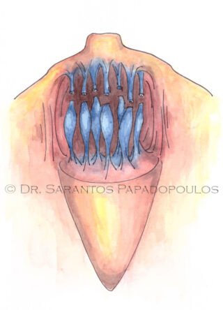 Χειρουργική τεχνική Urban 4