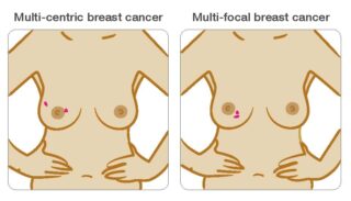 Πολυκεντρικός καρκίνος μαστού