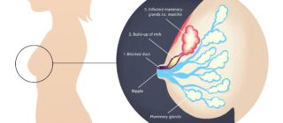 Σχεδιάγραμμα για τη μαστίτιδα
