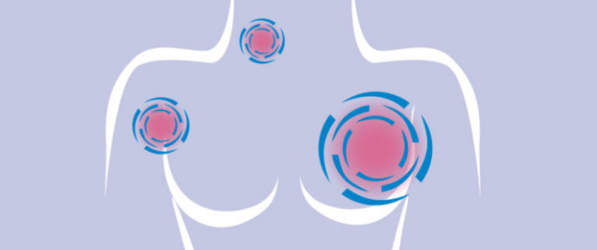 Σχεδιάγραμμα για την εξάπλωση του καρκίνου του μαστού