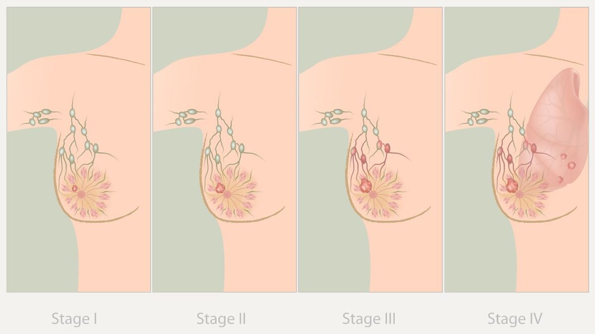 Σχεδιάγραμμα για τα στάδια καρκίνου του μαστού